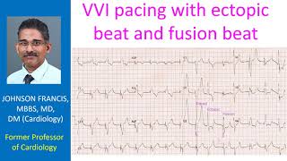 VVI pacing with ectopic beat and fusion beat [upl. by Elletnahs612]