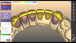 design dental crovn coping foe metalo ceramic design exocad 3 2 elefsinaexocad [upl. by Yseulte293]