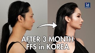 3 MONTHS AFTER FACIAL FEMINIZATION SURGERY IN KOREA [upl. by Yentruoc]