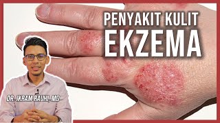 Ekzema Eczema  Apa Yang Anda Patut Tahu  Punca dan Penyebab  Ubat Ekzema  Bayi dan Dewasa [upl. by Bach602]