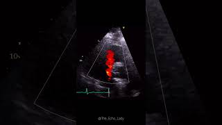 What type of VSD is this 🩵☝🏻 ventricularseptaldefect VSD echocardiography cardiology [upl. by Rednijar]