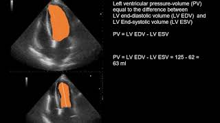 Echocardiography in the patient with acute anteroseptal myocardial infarction [upl. by Ynove]