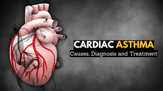 Cardiac Asthma Causes Signs and Symptoms Diagnosis and Treatment [upl. by Alimrahs]