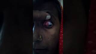 recorrent episcleritis from 2 years youtubeshorts shortvideo episcleritis eyedoctor doctor [upl. by Reppiks]