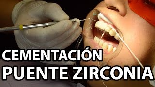 Cementación Puente Zirconia 6 Unidades👅Parte2 [upl. by Ransom]