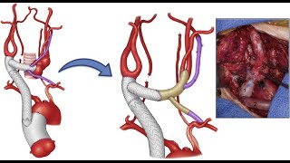 What Is Takayasu Arteritis  Symptoms Complications amp Treatment Methods [upl. by Biddick]