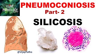 PNEUMOCONIOSIS Part 2 Silicosis pathogenesis morphology  clinical features amp complications [upl. by Scharf31]