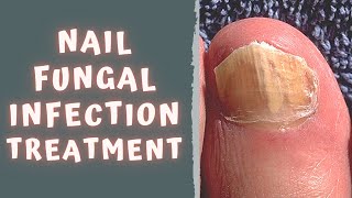 HOW TO TREAT FUNGAL NAIL INFECTION  TINEA UNGUIUM  ONYCHOMYCOSIS [upl. by Ahsatal117]