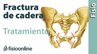 Fracturas de fémur cadera y pelvis  Tratamiento y cuidados para su recuperación [upl. by Erasaec]