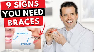 9 Signs you Need Braces  Overjet overbite crowding [upl. by Burkley]