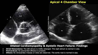 Dilated Cardiomyopathy amp Systolic Heart Failure Echocardiography Report Example  Cardiac Diseases [upl. by Jan]