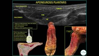 APONEUROSIS PLANTARIS Fascia plantar [upl. by Mcilroy]