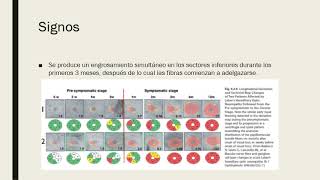 Neuropatía óptica hereditaria de leber NOHL [upl. by Dwayne]