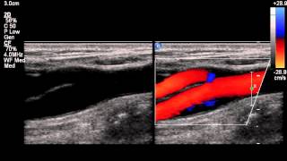 NORMAL CAROTID ARTERY COLOR COMPARE [upl. by Eciruam]