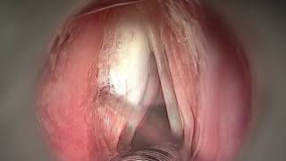 PHONOSURGERY  LEFT VOCAL FOLD PALSY [upl. by Eolande]