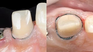 Dental basics Gingival Retraction  The two cord technique [upl. by Wyatan]