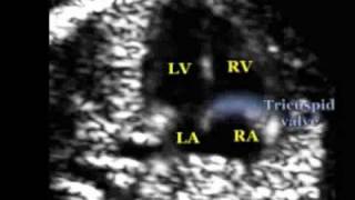 Fetal Medicine Foundation  Tricuspid flow [upl. by Nospmas]