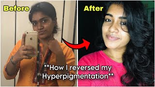 How I Reversed My Hyperpigmentation With Products Details [upl. by Frost]