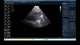 IQ 290 TFAST LUNG MASS ULTRASOUND ICP CPP ECHOPAC ANALYSIS 00 [upl. by Yorztif]