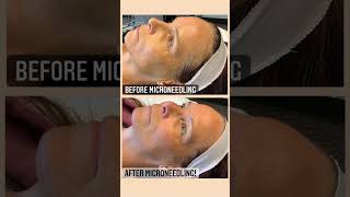 The Many Benefits of Microneedling [upl. by Orthman704]