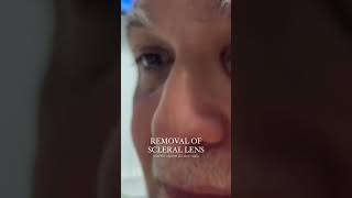 Removing Scleral Lenses [upl. by Melas]