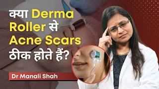 क्या Derma Roller से Acne Scars ठीक होते हैं  Is it the Secret to Perfect Skin  Clear Skin Pune [upl. by Pinelli535]