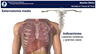 Abordajes en Trauma de Tórax Dr Jesús Lugo [upl. by Claybourne]