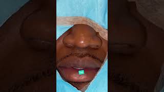 NOSTRIL NARROWING ALARPLASTY  DR TANVEER JANJUA NEW JERSEY [upl. by Selby]