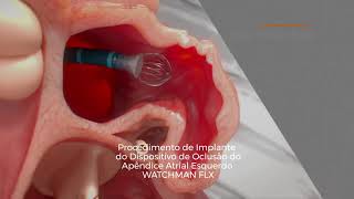 WATCHMAN FLX Dispositivo de Oclusão do Apêndice Atrial Esquerdo da Boston Scientific [upl. by Sharona]