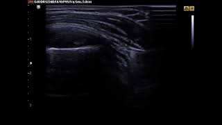 Ultrasound Guided Subacromial Bursa Injection [upl. by Aural]