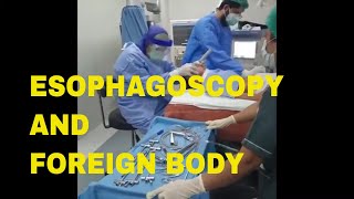 Covid and Esophagoscopy  Endoscopy and Foreign Body removal  Dr Sultan Badar Munir  Endoscopy [upl. by Jorgenson]