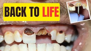 Need a Tooth Implant Alternative See How Dentist save teeth with Crown and Filling [upl. by Oiluj352]