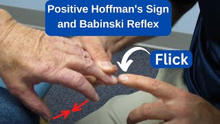 Positive Hoffmans Sign and Babinski Reflex in an MS Patient [upl. by Kcirdderf]