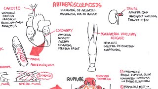 Atherosclerosis  Pathophysiology [upl. by Jakob]