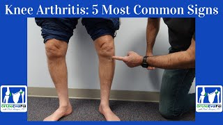 Knee Arthritis 5 Most Common Signs You Have It [upl. by Ahtelahs]