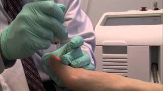 Genesis plus Laser in Long Beach CA at A Step Above Foot Care [upl. by Itoc]