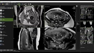 Webinar Summer Session 2024 The Clinical Impact of Fetal Cardiac MRI [upl. by Nalaf39]