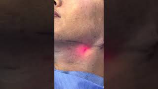 Double chin fast fat removal in 10 minutes with Forza Lipolaser [upl. by Waers]