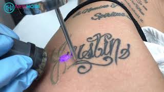 Laser Tattoo Removal  Removing name tattoo off hip  Newhope Laser Skin Care  Orange County [upl. by Norod]