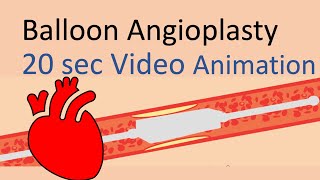 Balloon angioplasty animation 20 seconds for peripheral vascular disease  coronary artery disease [upl. by Lawson]