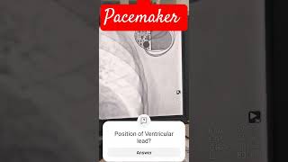 PacemakerPPI Permanent pacemaker [upl. by Renferd489]