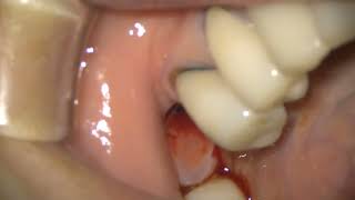 Straumann TLX in posterior mandible [upl. by Elbam]