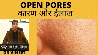 ओपन पोर्स के कारण और ईलाज  OPEN PORES CAUSES amp TREATMENT DR VINEET BIKANER VR SKIN CLINIC [upl. by Ardnuhs]