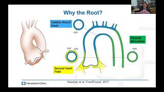 Dr Eric Roselli on Aortic Root Surgery in Connective Tissue Conditions [upl. by Quince]