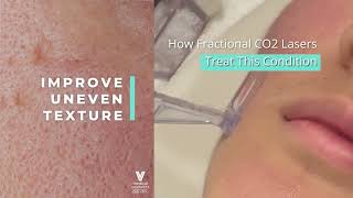 Fractional CO2 Laser Singapore  FAQ  Acne Scars Treatment [upl. by Zetrac]