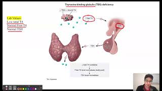 Thyroxine Binding Globulin TBG Deficiency [upl. by Tnafni546]