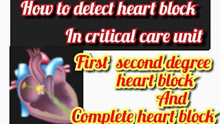 Heart block Atrioventricular block  AV block  ECG of heart block  mobitz type 1 and 2 [upl. by Surad315]