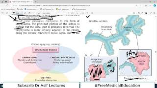 Chp13 Robbins Patho  Lung Pathology  EMPHYSEMA  Obstructive Lung Diseases [upl. by Saffian983]