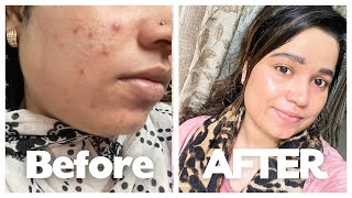 Skin Care  Morning Skin Routine  morning vlog  acne [upl. by Rezeile652]