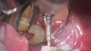 operculectomy of mx 3dr molar [upl. by Zigrang]